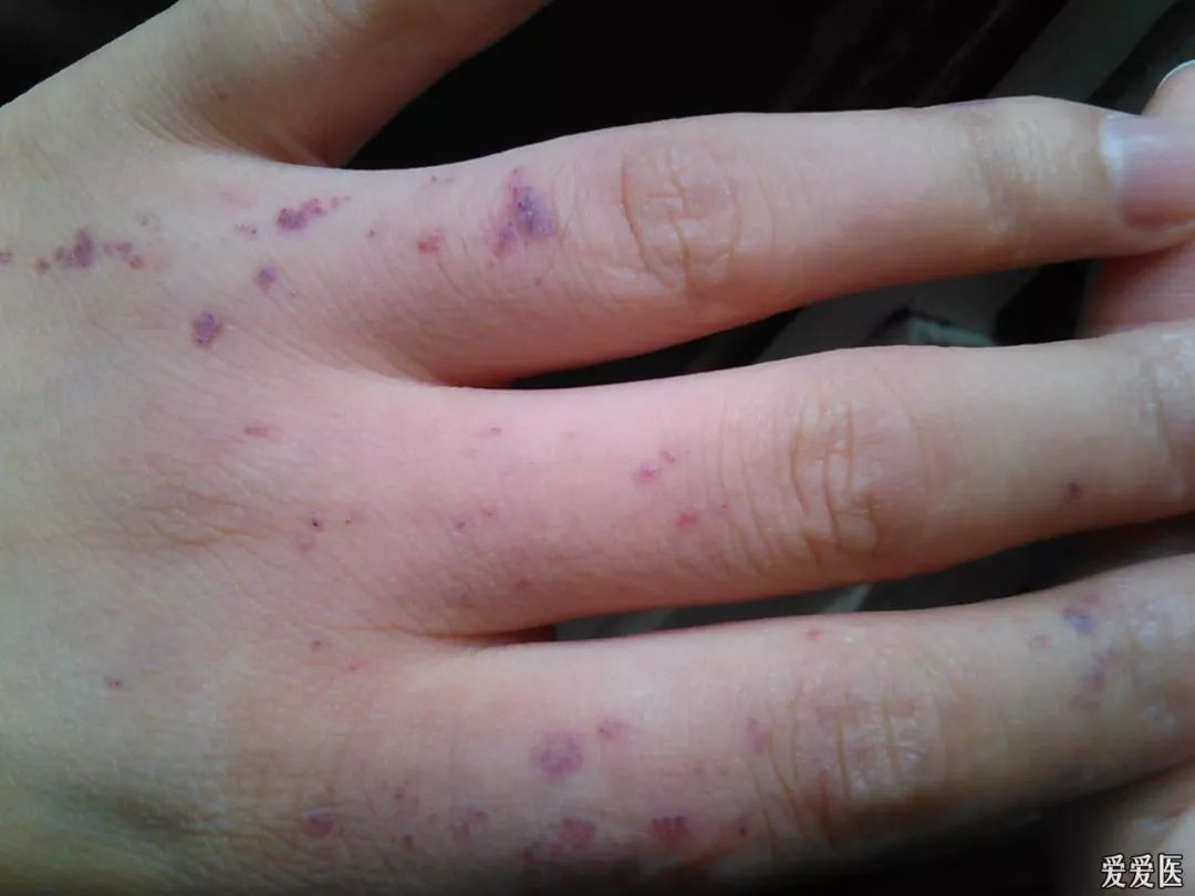 身上红痣怎么治疗,身上长红痣什么原因