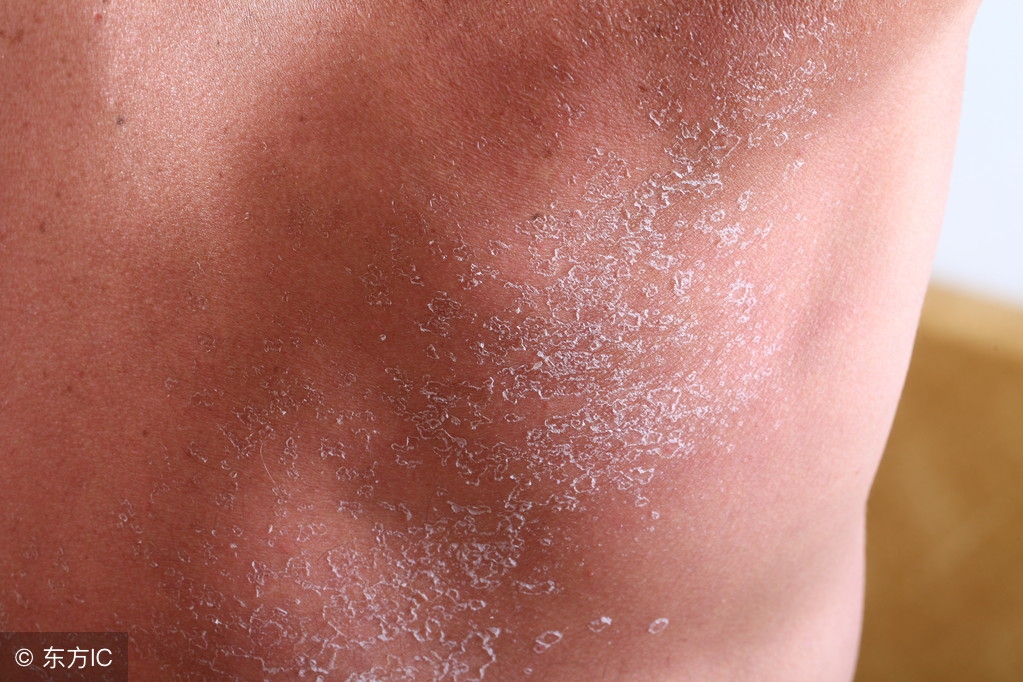 有谁知道手脱皮是怎么回事,手脱皮怎么回事吃啥维生素