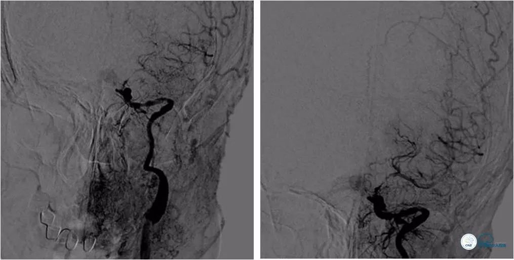 天坛医院住院日记,颈内动脉c5到c7段狭窄微创手术