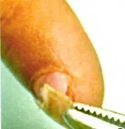 手足口病来袭如何护孩子周全,新型手足口和普通手足口