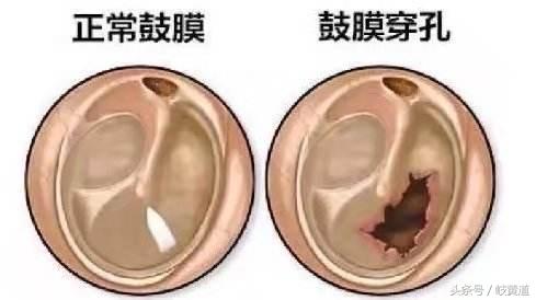 吵架打自己耳光会不会影响到耳鸣,女人和丈夫吵架耳鸣怎么办