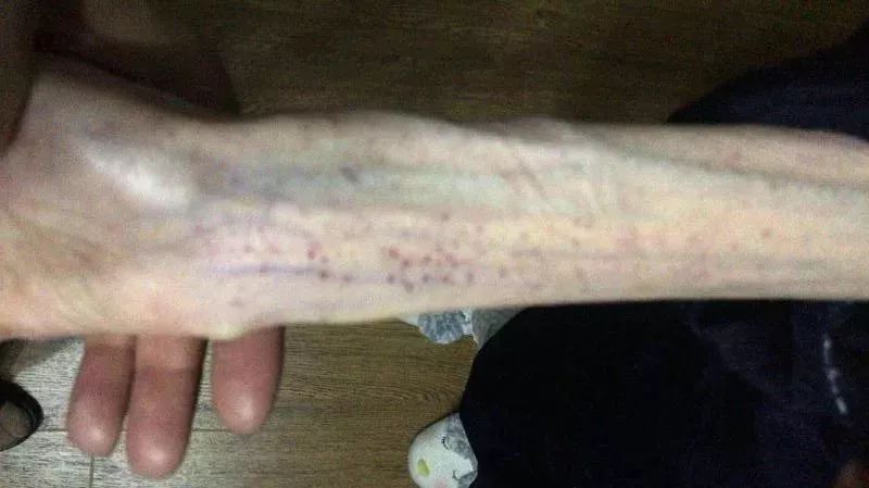 1米67才50斤!21岁女孩“自杀式减肥”,哈医大好几个科医生联手才把她救过来……