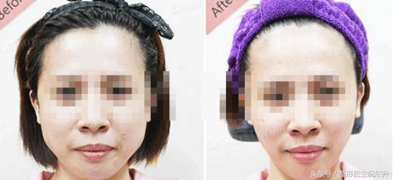 脸胖了还能瘦下来吗,脸胖了很多要怎么瘦