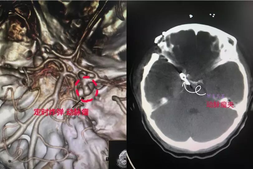 「技术硬实力」不断创新发展的玉田县中医医院脑病四科！