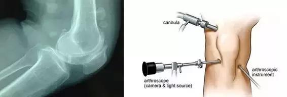 膝关节有轻微卡住的感觉怎么办,膝关节像被卡住疼痛怎么办