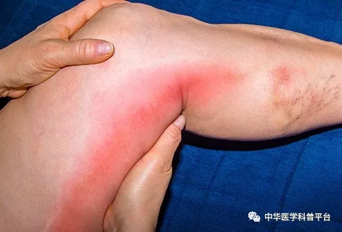 你需要知道的睡眠知识,医生告诉你血栓那些事