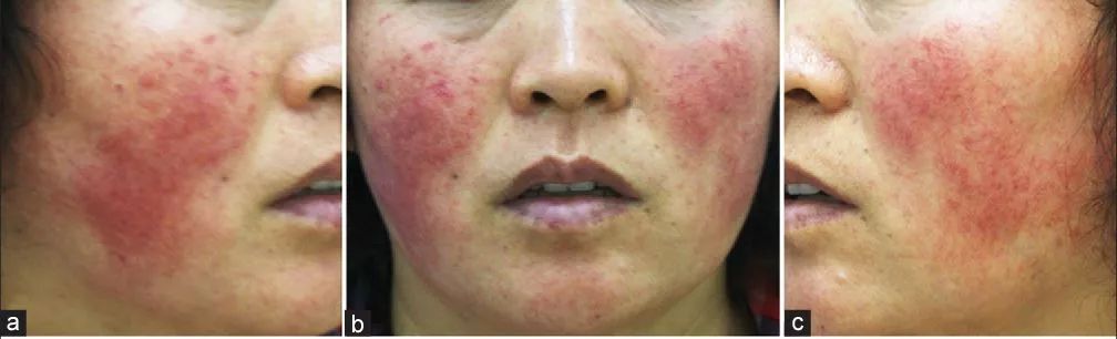 激素药膏烂脸还有救吗,用医生开的药膏会不会成为激素脸