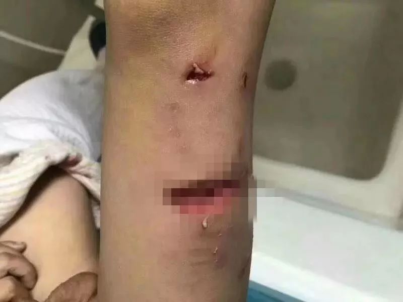 被狗咬住不放怎么办,被狗咬着不松口怎么快速脱离