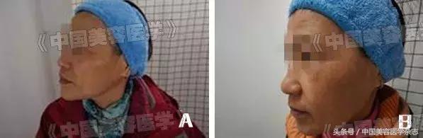 药物水光注射治疗*褐斑黄**对患者CK10、SOD及MDA表达水平的影响