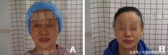 药物水光注射治疗*褐斑黄**对患者CK10、SOD及MDA表达水平的影响