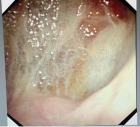 胸水抽了为什么还呼吸困难,胸水抽不出来了怎么回事