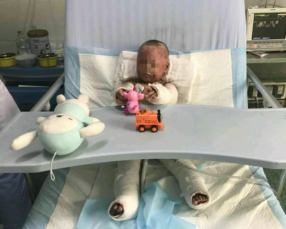 煤气爆炸烧伤的两个孩子,13岁孩子煤气爆炸重度烧伤