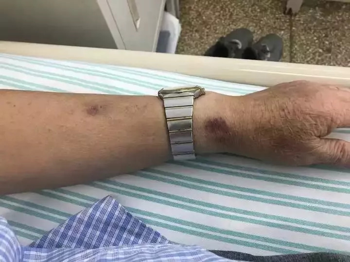 天呐！大爷3年吃掉100多支“皮炎平”软膏！