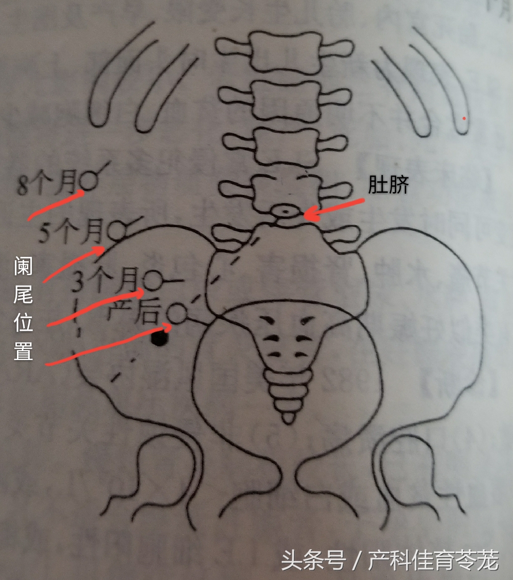 妊娠期急性阑尾炎的处理原则,妊娠期急性阑尾炎最佳治疗方案