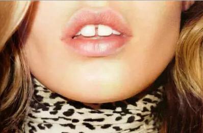 牙齿松动还有缝越来越大,牙齿太稀牙小缝大怎么矫正