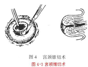 发现宫颈癌前病变能治愈吗,宫颈癌患者发现病因
