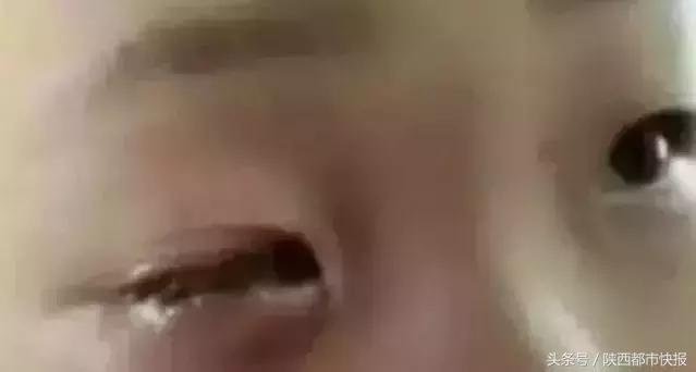 男童眼球瞬间被融化,孩子眼球被融化的东西很常见