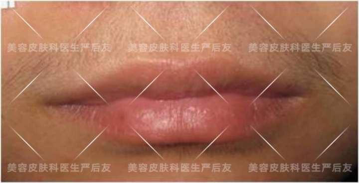 上海面部激光脱毛,日本全身激光脱毛