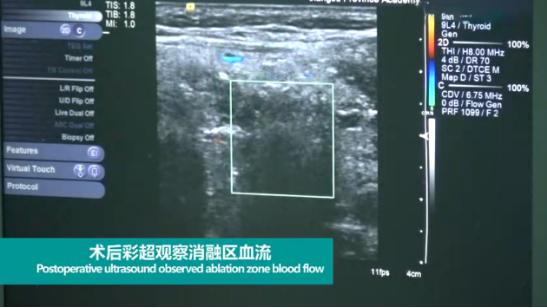 微波消融术，让甲状腺患者康复“加速度”