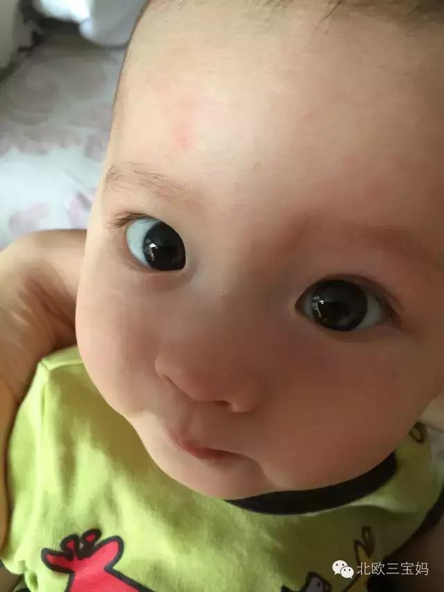 怎么分辨宝宝热疹湿疹荨麻疹,幼儿急疹和湿疹风疹有什么区别