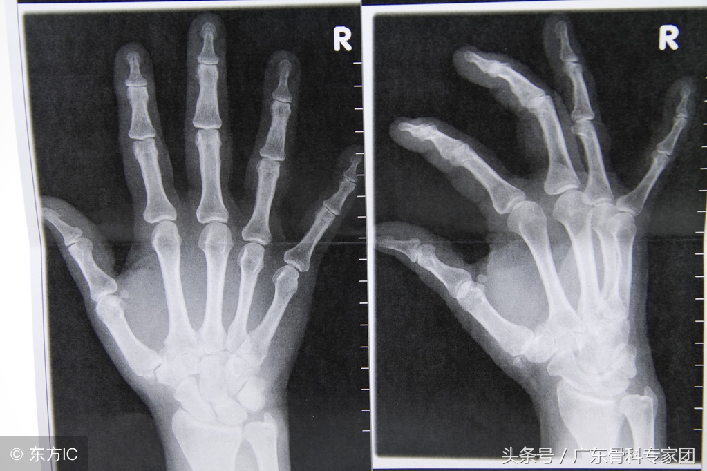 手腕骨折多少天后能不疼？没有做好这6点白白受苦