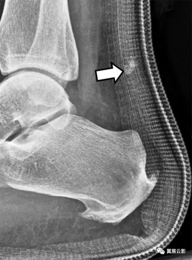 轻微骨裂容易被误诊,临床容易误诊的影像片子