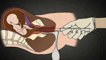 堕胎是杀人吗,堕胎就是杀生