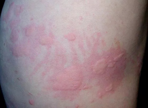 急性荨麻疹痒可以挠吗,荨麻疹挠痒后皮肤上出现红斑