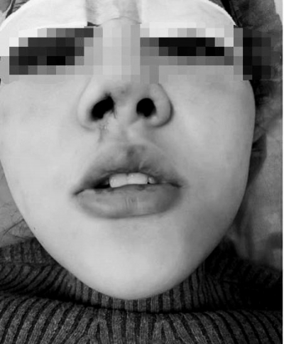 大三女生在欧兰整形*款贷**整容，术后感染且俩鼻孔一大一
