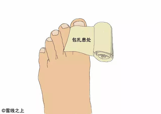 陶冶重庆｜徒步时，如何防治水泡？