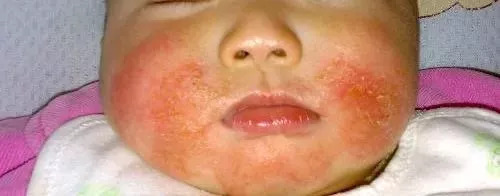 成年人反复湿疹的最佳治疗方法,湿疹水泡反复发作有没有土方法