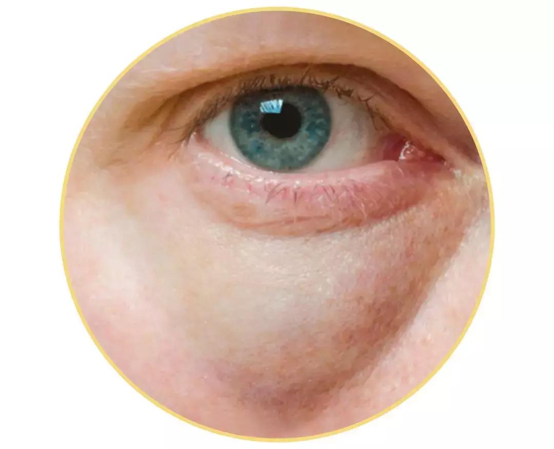 解决黑眼圈细纹最有效的方法,黑眼圈细纹比较严重怎么办