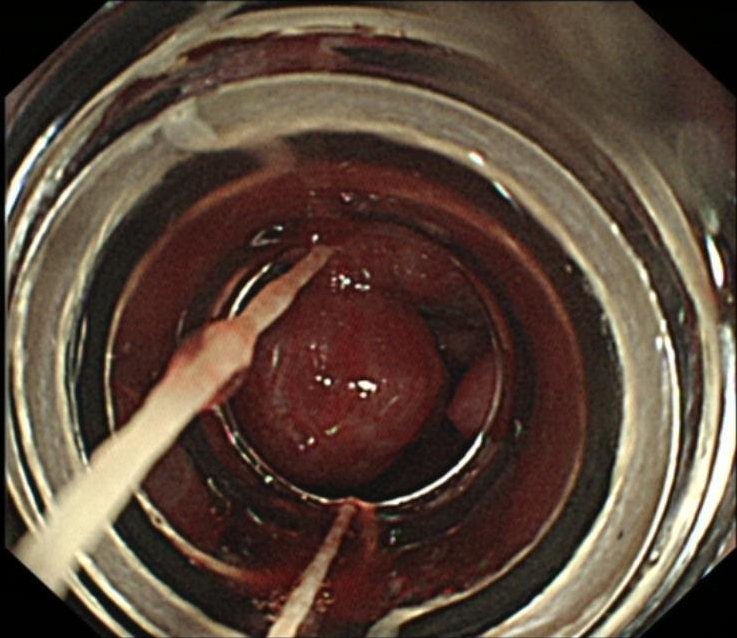 肝硬化中西医结合治疗并发症,肝硬化tips介入手术并发症