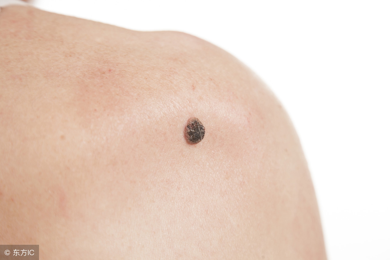 常见皮肤癌怎么识别,最容易分辨的皮肤癌症状是什么