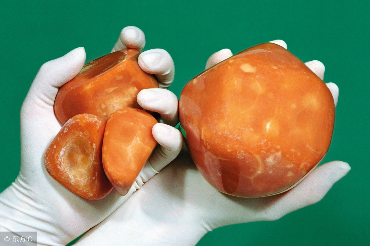 胆结石与胃病的区别,胆结石与胃病如何区分症状