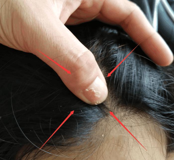 怎么除头螨虫最有效方法,头上螨虫怎么去除简单方法