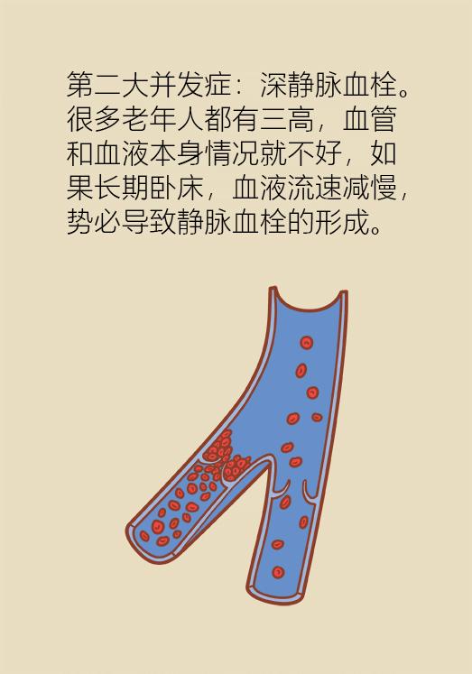 老人股骨颈骨折后死亡率高达50%，提醒爸妈一定要注意！