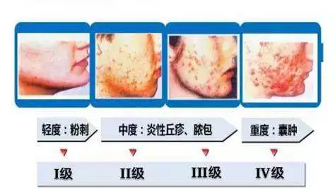 七年级成长的烦恼青春痘,青春痘带来的烦恼