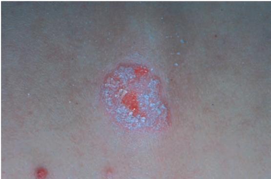 牛皮癣是严重疾病吗,牛皮癣属于什么类疾病