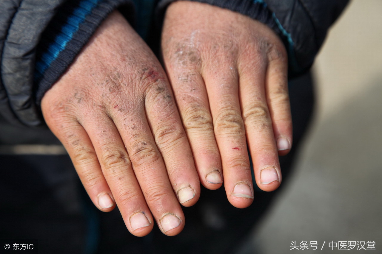 清热凉血祛风止痒,清热解毒祛风凉血活血化瘀