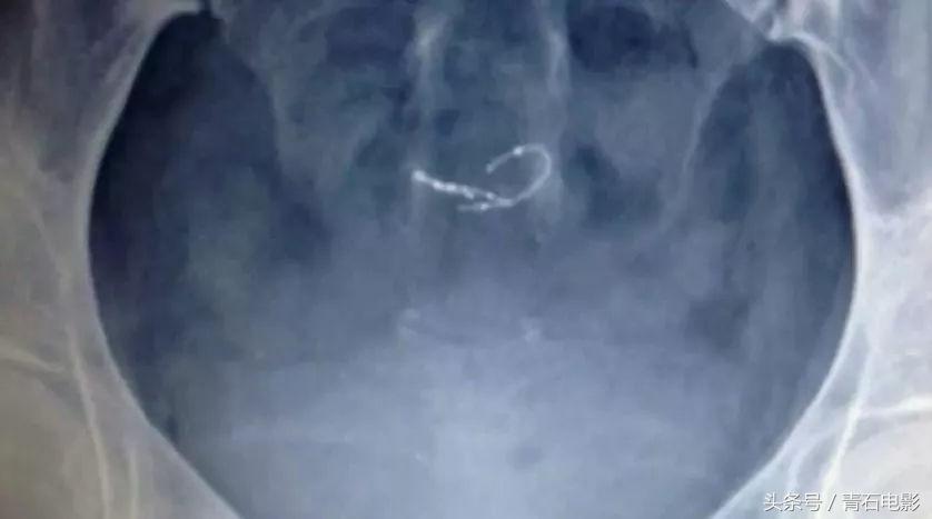 网飞出品的纪录片，上映后让美公司停售一款尖端医疗器械！