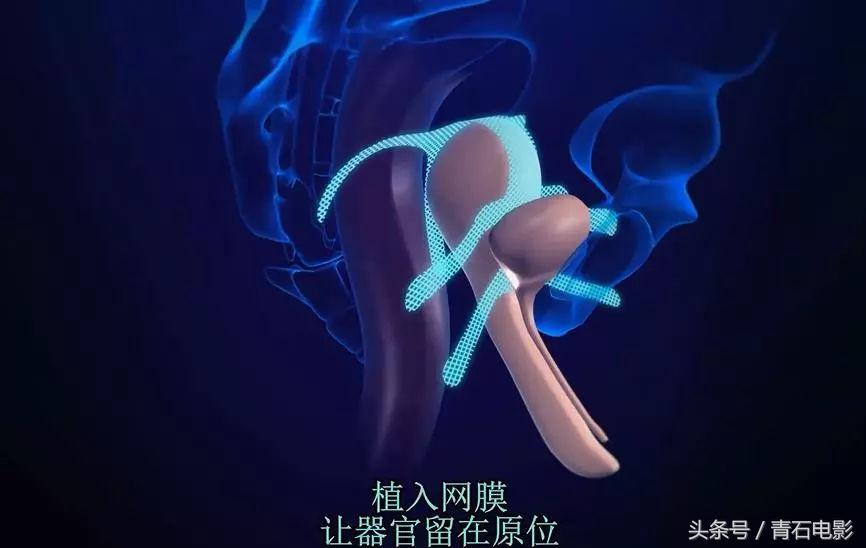 4公分线圈可避孕，护士曾为其代言，但纪录片上映后产品遭停售！