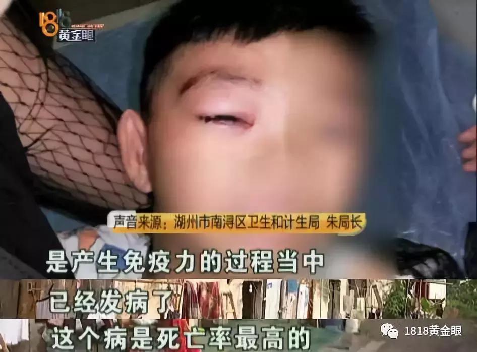 湖州6岁男童被狗咬伤,十几天后没了,确诊为狂犬病,听医生讲讲被狗咬伤后怎么处理