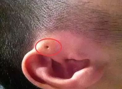 孩子耳朵旁边长了个聪明孔,婴幼儿耳朵长出聪明孔