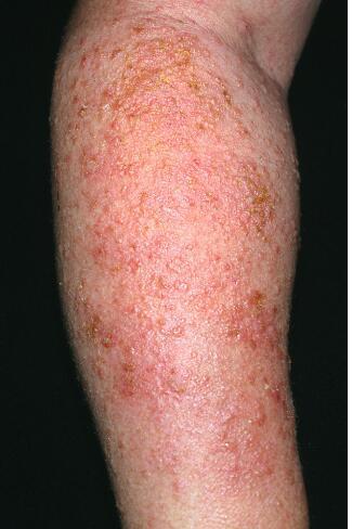 孩子湿疹吃什么药,8岁孩子湿疹