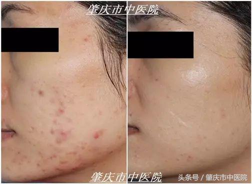 「答疑」为什么过了青春期还会长“青春痘”？