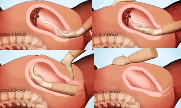 谁说第三产程不疼？几位宝妈分享的“手剥胎盘”之痛，比顺产还疼