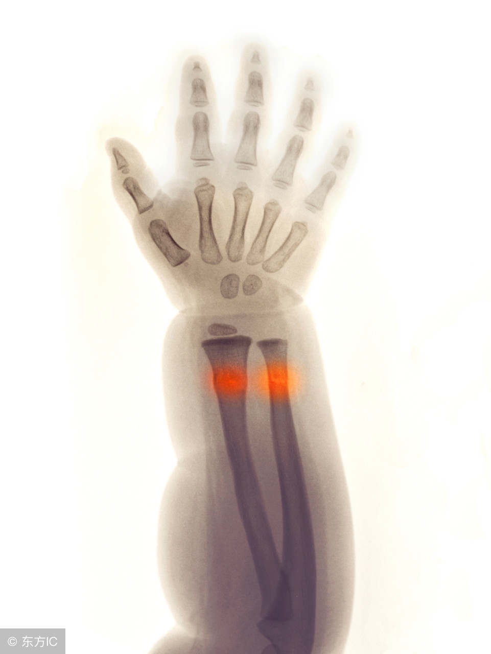 小孩子骨折不可以用药吗,小孩有点骨折不打石膏可以吗