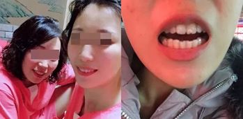 网上缺牙补贴是真的吗,缺牙人士看过来种牙补贴免费领