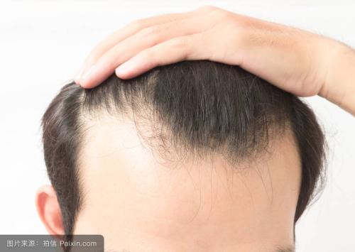 防脱发小妙招,解决你的燃眉之急
